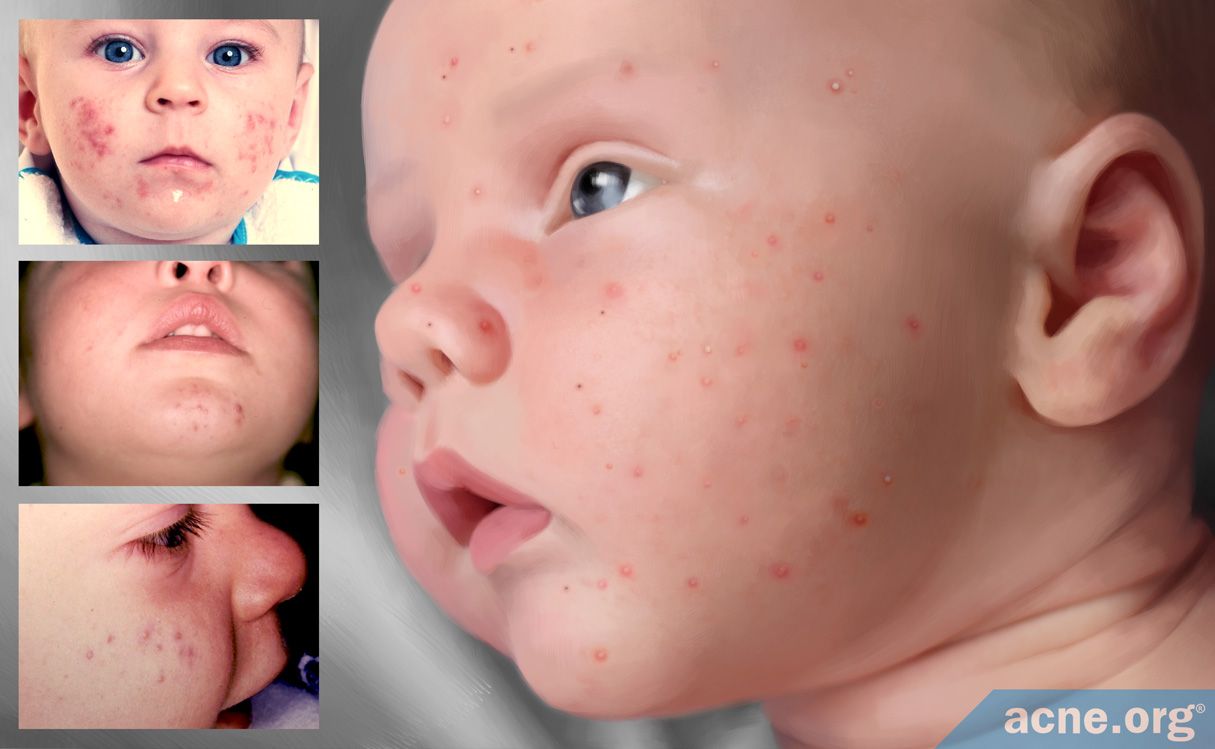 Baby Acne What Is It And What Causes It
