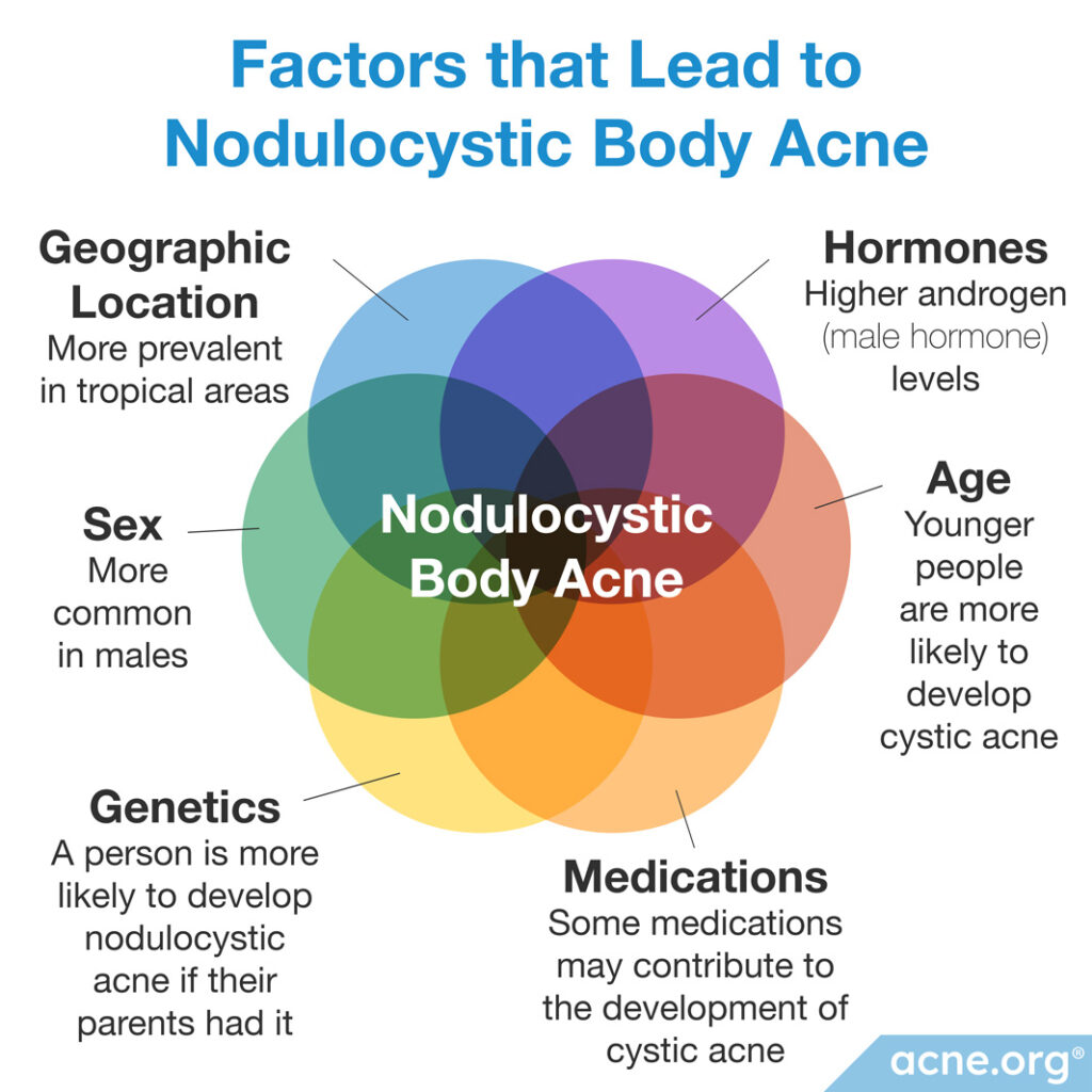 Factors that Lead to Nodulocystic Body Acne
