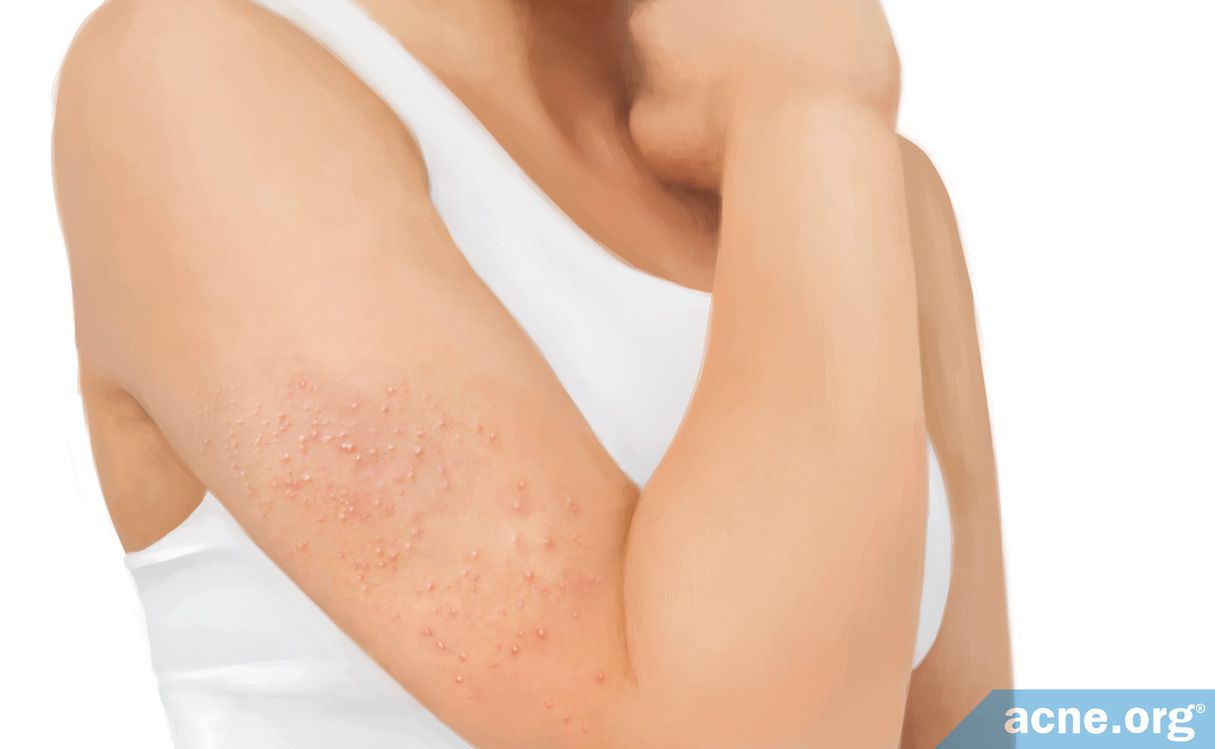 Keratosis Pilaris Symptoms Causes And Treatments Acne Org