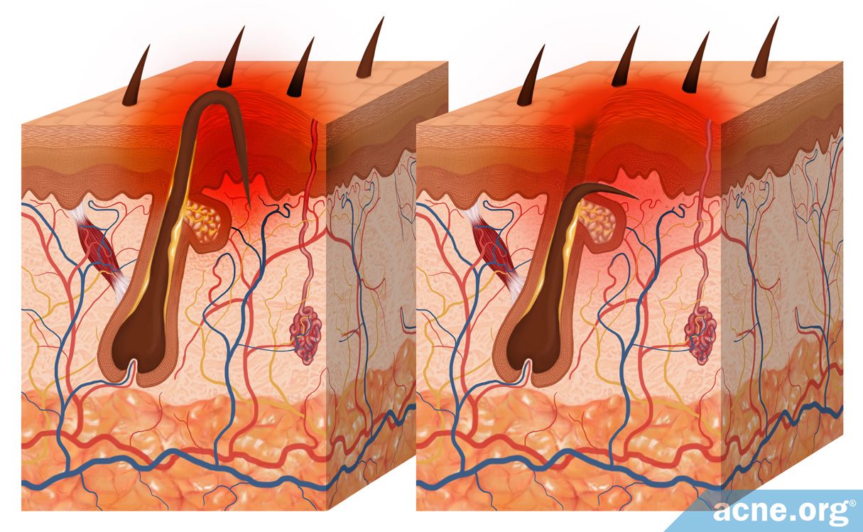 What Are Ingrown Hairs