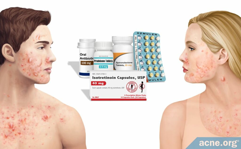 Homeopathic Medicine For Cystic Acne What's the Best Treatment for Cystic Acne? - Acne.org