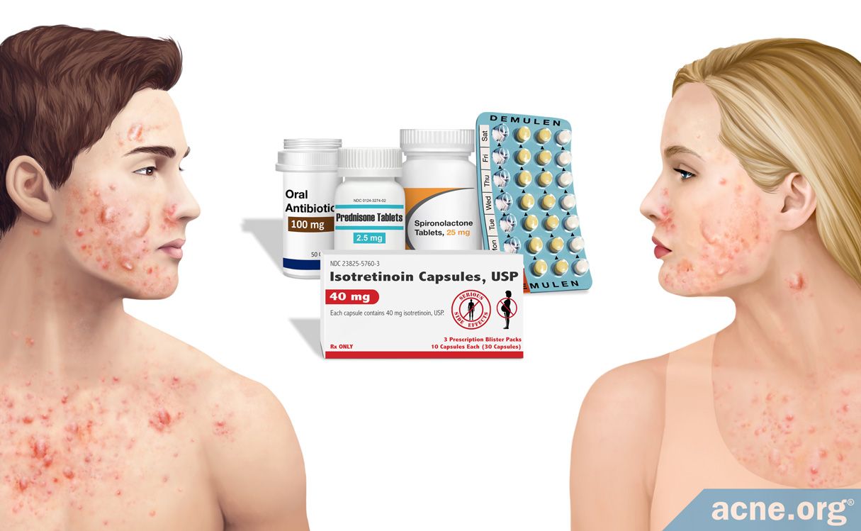 What s The Best Treatment For Cystic Acne 45 OFF