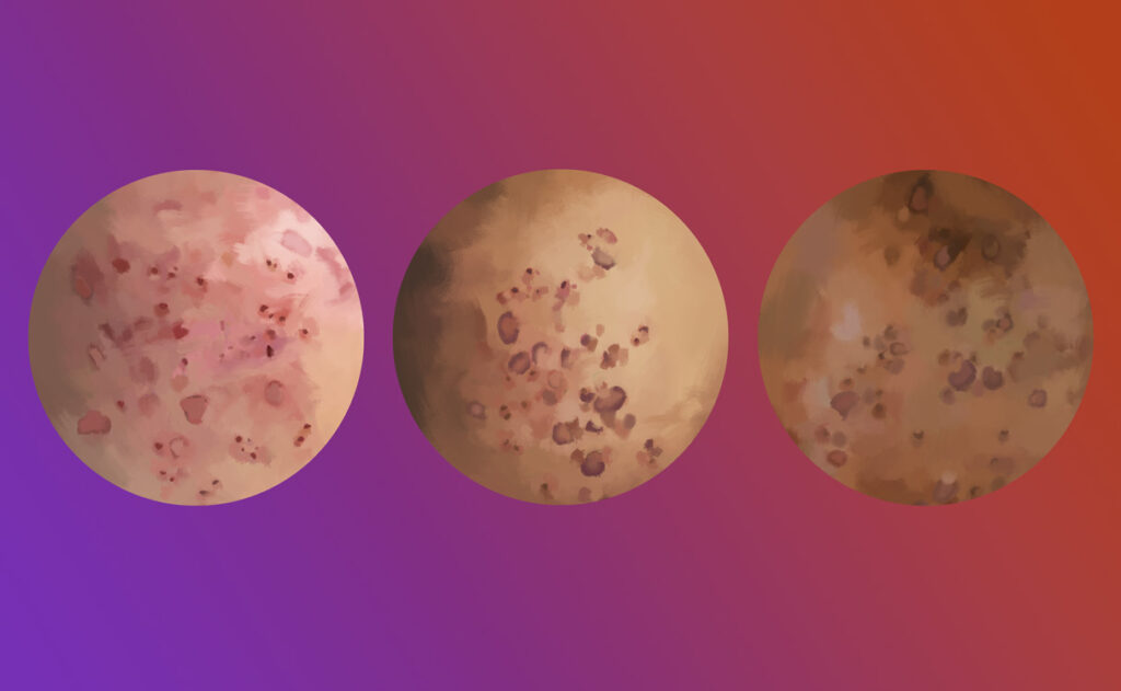 Why Acne Scars Are Red/Purple