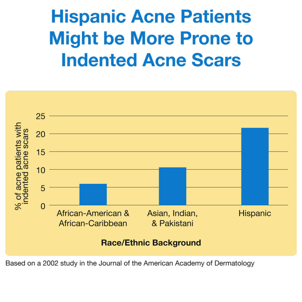Hispanic Acne Patients Might be More Prone to Indented Acne Scars