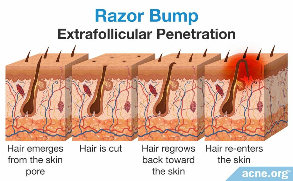 Razor Bump Extrafollicular Penetration