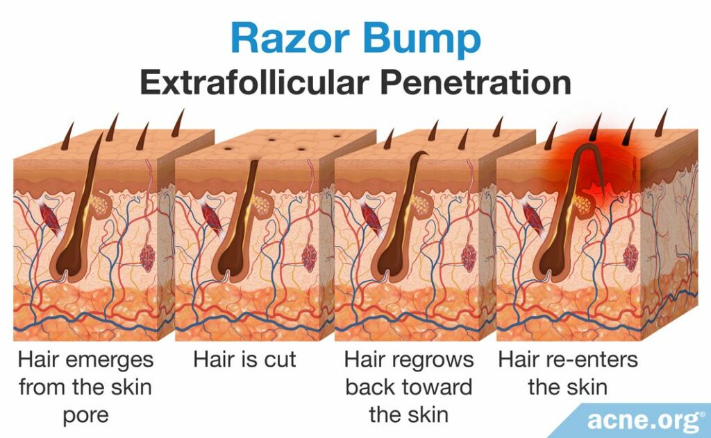 Razor Bump Extrafollicular Penetration