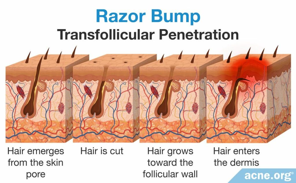 Razor Bump Transfollicular Penetration