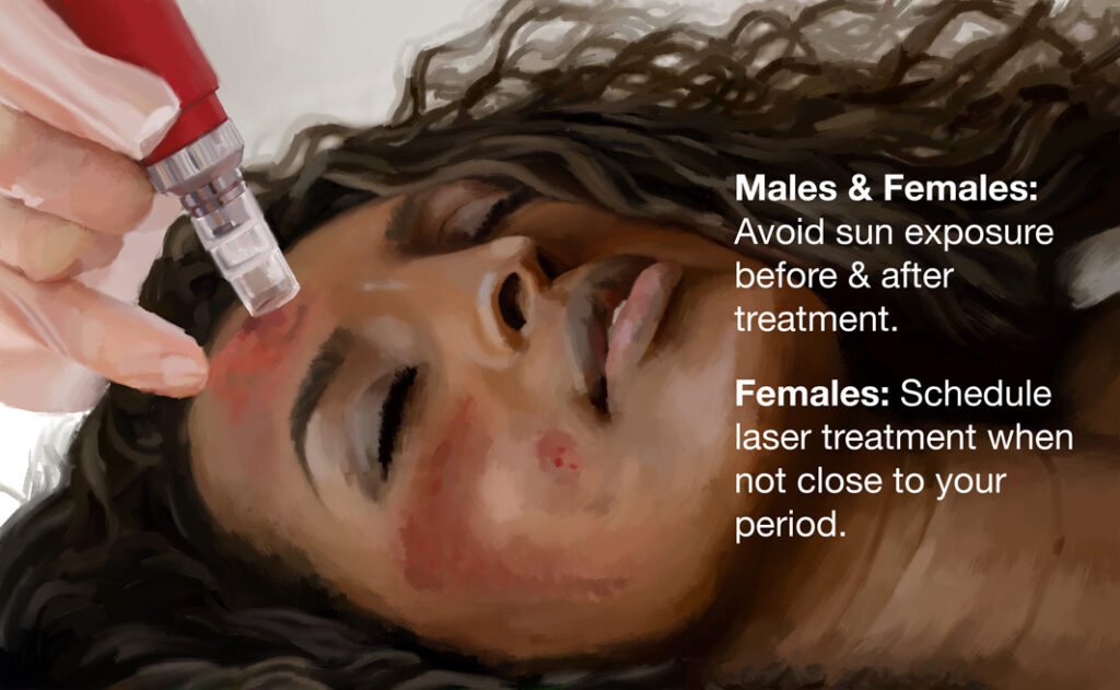 Males and females avoid sun exposure before and after treatment. Females schedule laser treatment when not close to your period. 