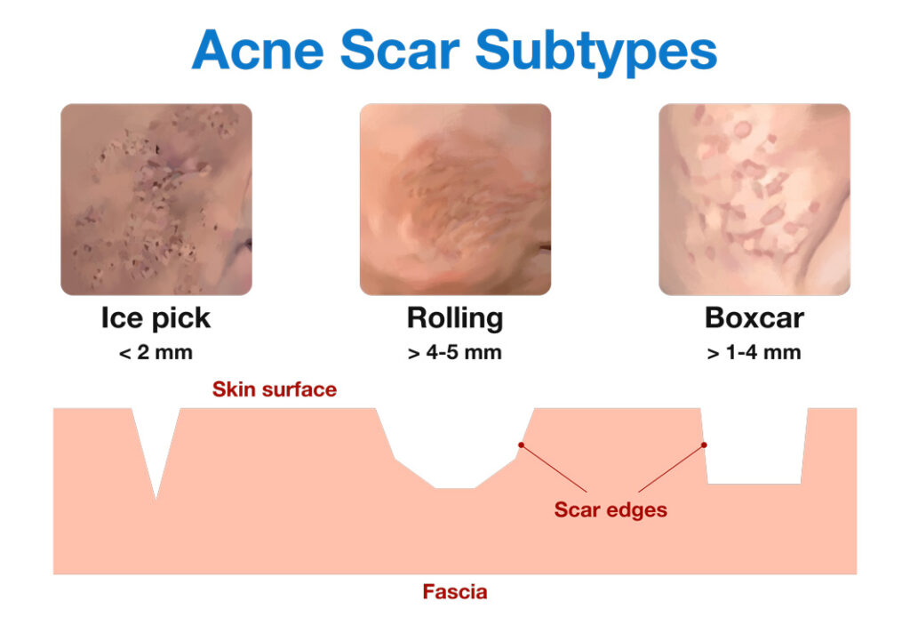 Acne scar subtypes