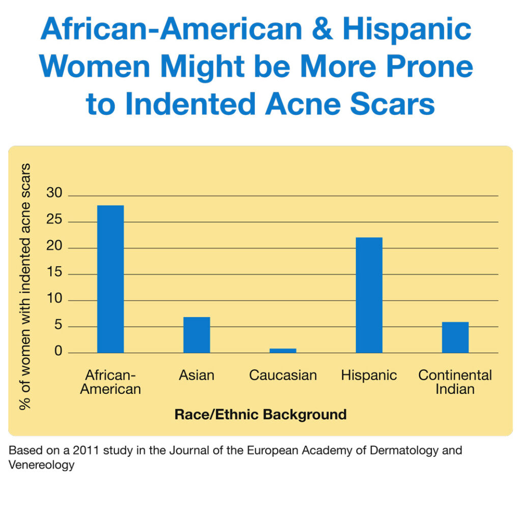 Africa-American and Hispanic Women Might be More Prone to indented Acne Scars
