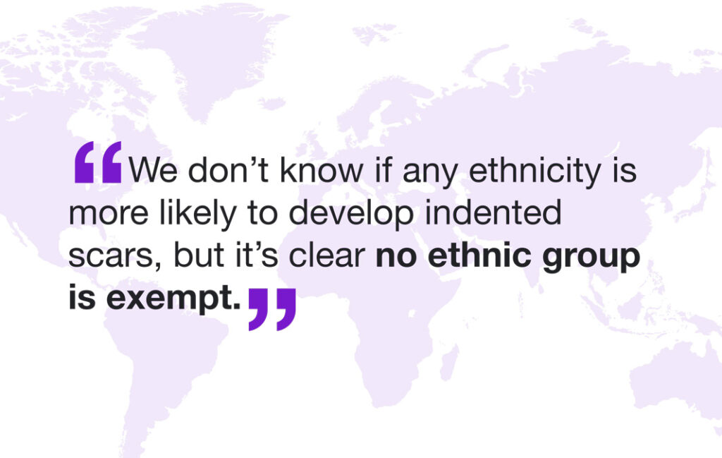We don't know if any ethnicity is more likely to develop indented scars, but it's clear no ethnic group is exempt. 