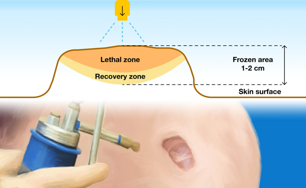 Cryotherapy device and keloid
