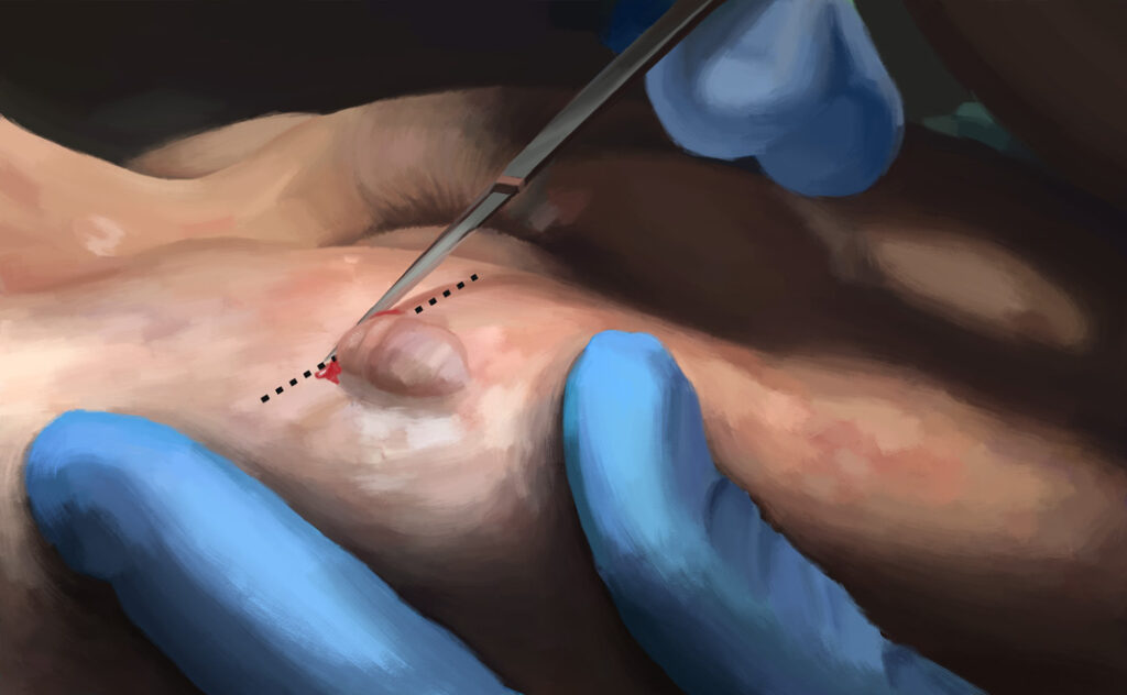 A doctor performs excision of a raised scar with a scalpel
