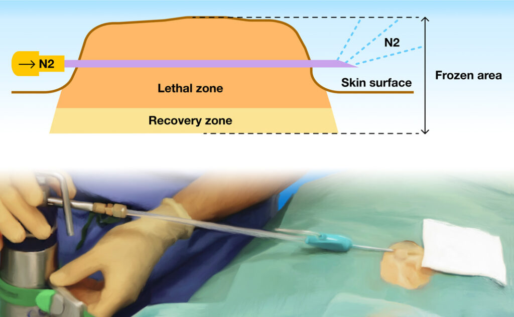 Intralesional Cryotherapy