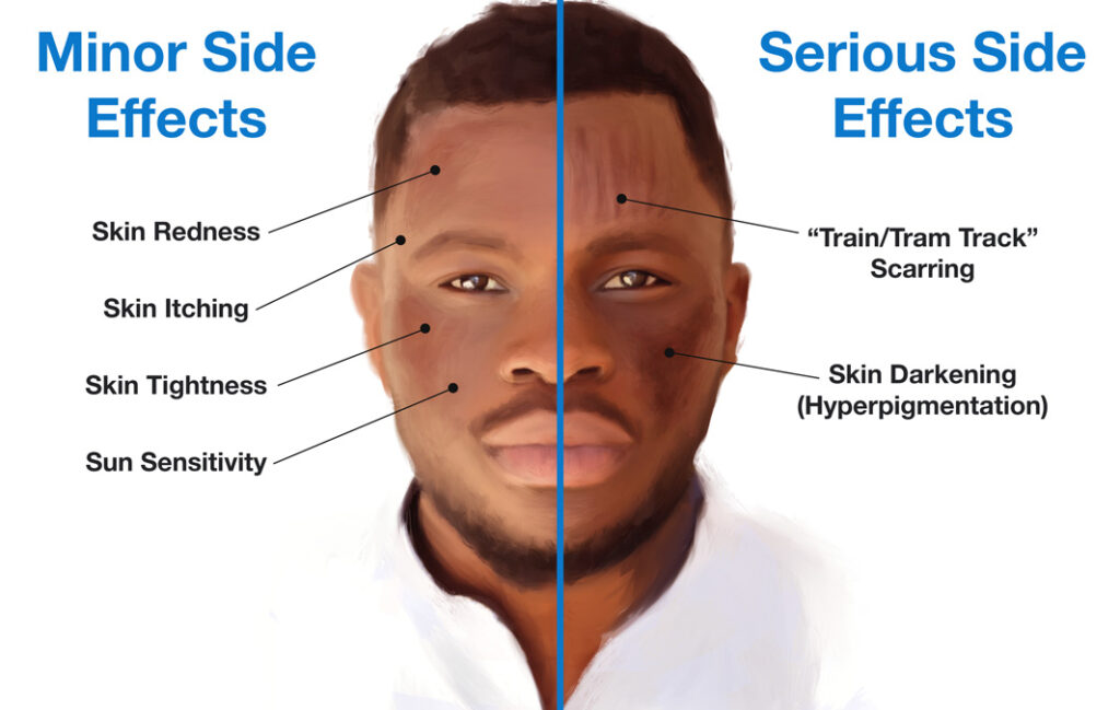 Microneedling side effects