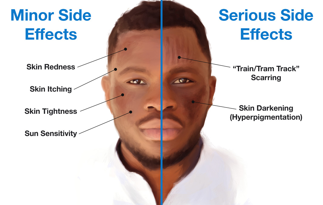 Microneedling and Acne Scars