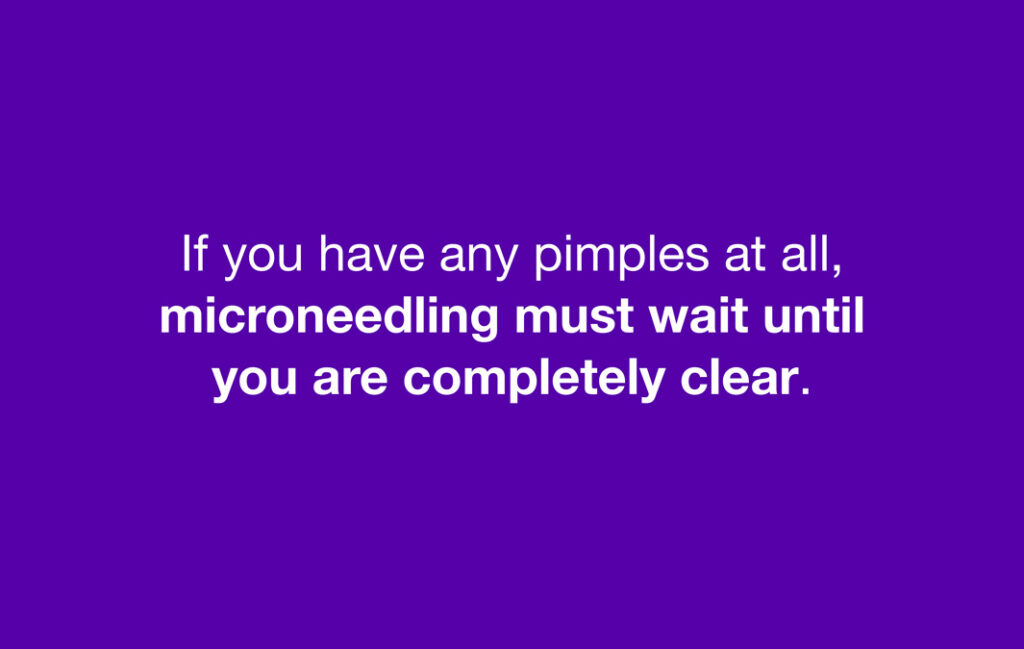 If you have any pimples at all, microneedling must wait until you are completely clear.