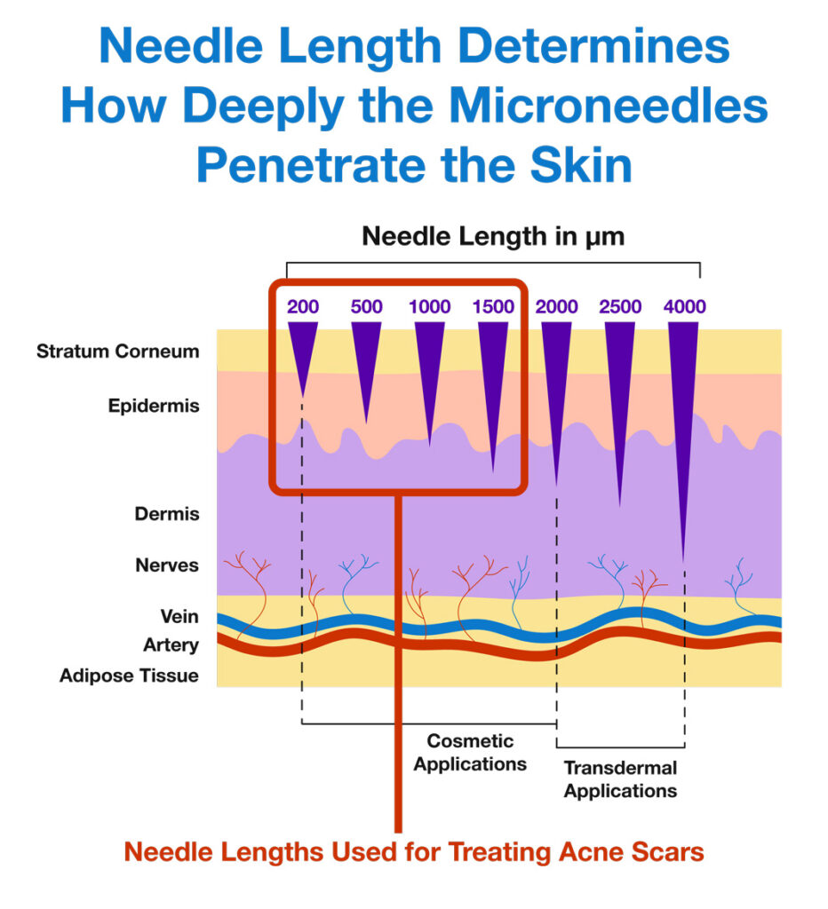 Needle length determines how deeply the microneedles penetrate the skin