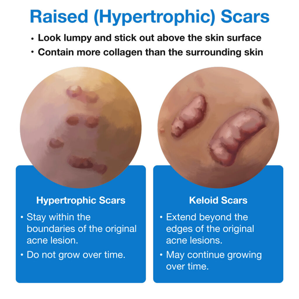 Raised Hypertrophic Scars Infographic