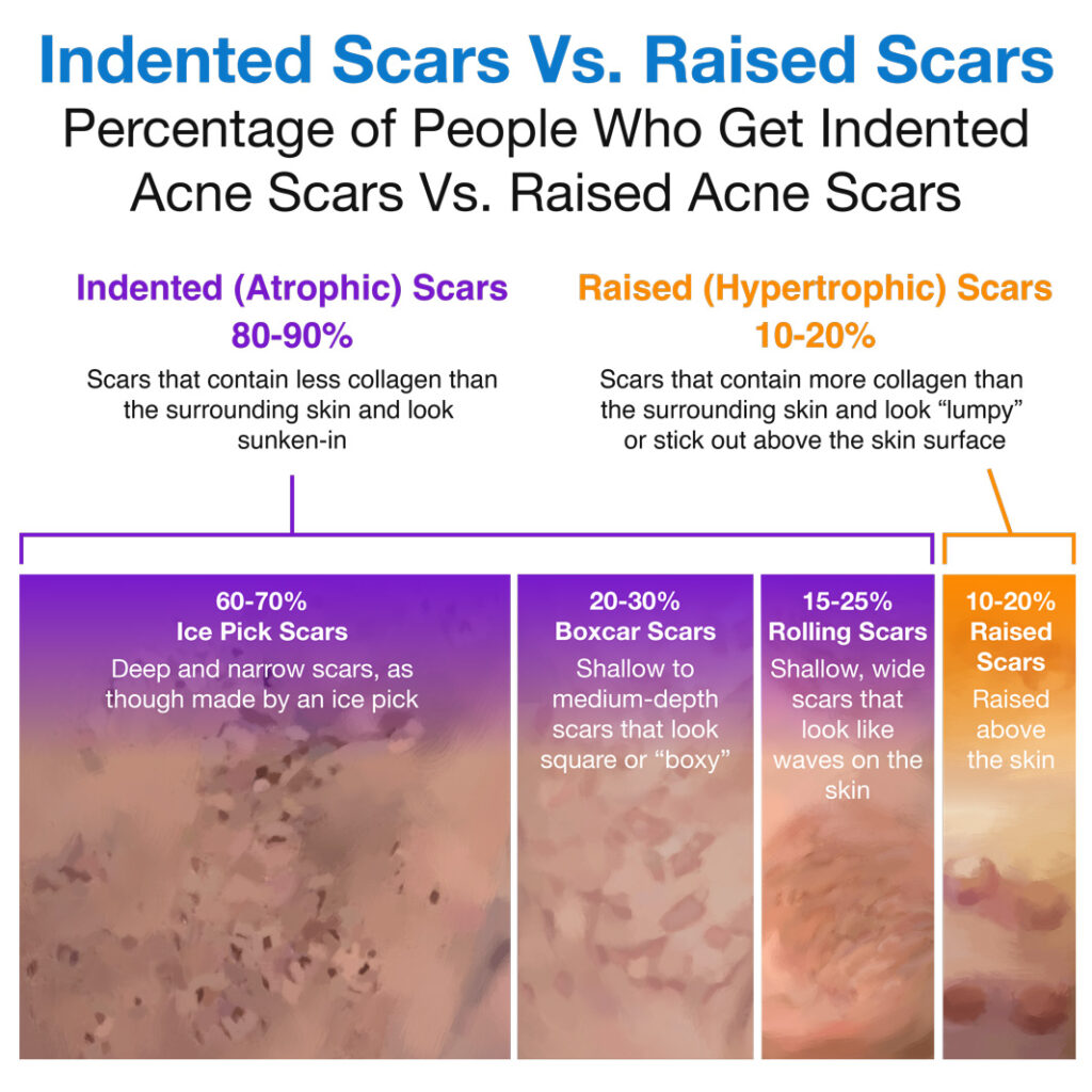 Percentage of people who get indented acne scars vs. raised acne scars