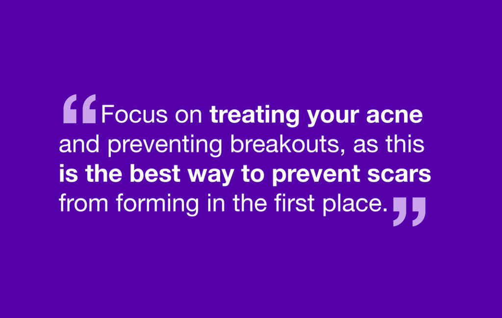 Focus on treating your acne and preventing breakouts, as this is the best way to prevent scars from forming in the first place. 