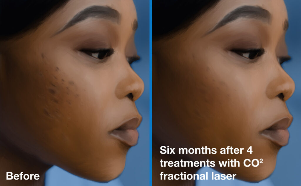 Acne scars before and after 4 treatments with CO2 fractional laser