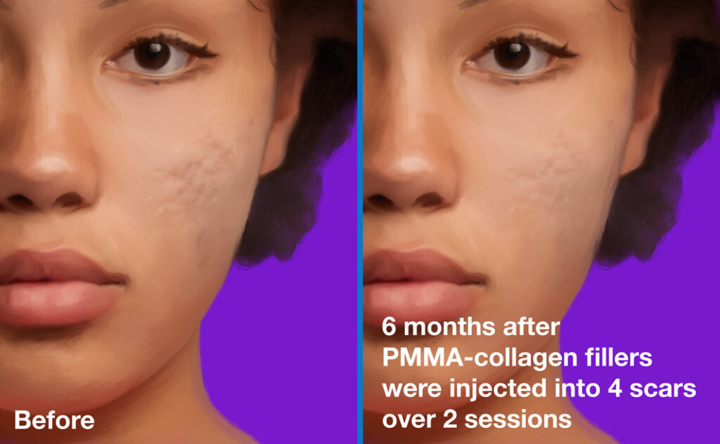 Acne scars before (left) and 6 months after (right) PMMA-collagen fillers were injected into 4 scars over 2 sessions