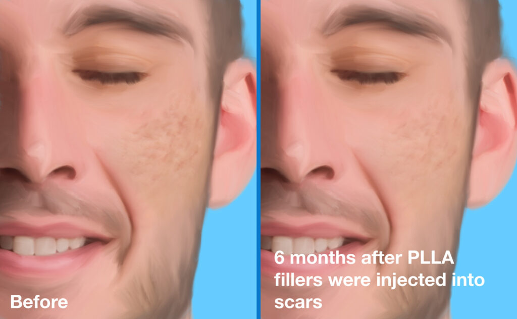 Acne scars before (left) and 6 months after (right) PLLA fillers were injected into scars