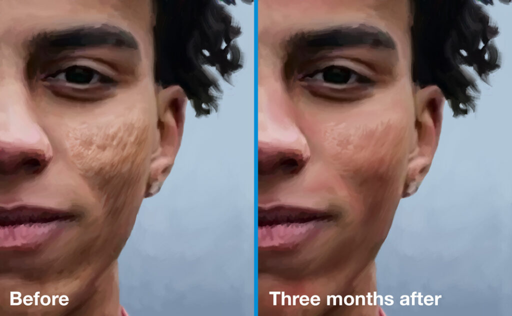 Acne scars before and 3 months after dermabrasion