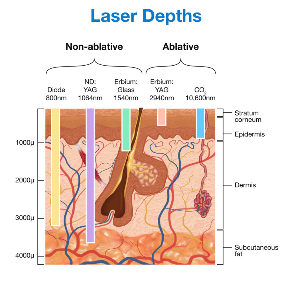 Laser depths