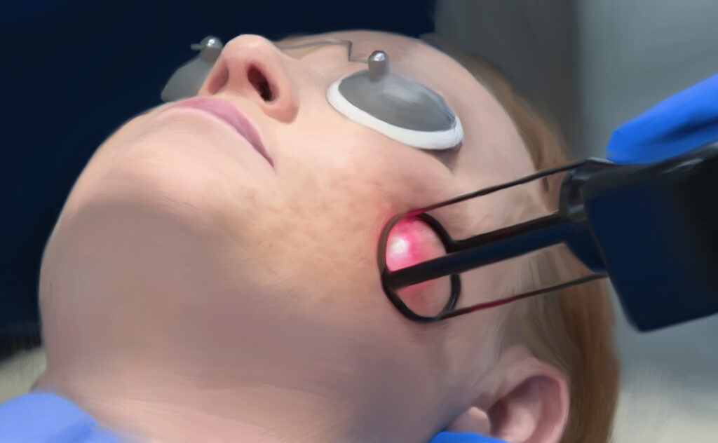 Laser treatment