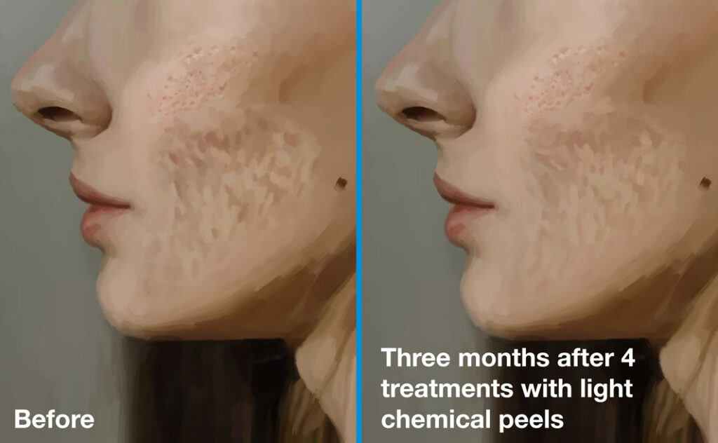 Superficial laser before and after picture
