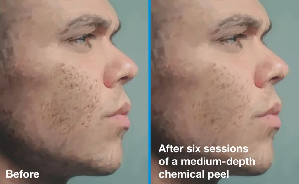 Acne scars before (left) and after six sessions (right) of a medium-depth chemical peel
