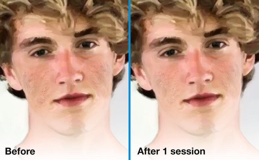Acne scars before (left) and after (right) one session of skin needling