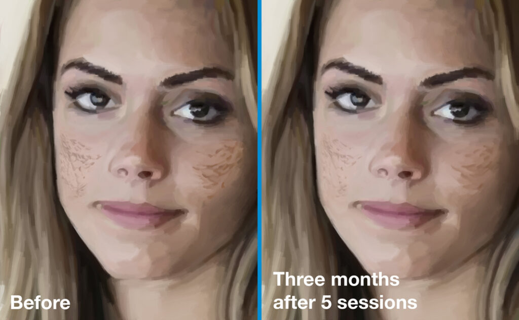 Atrophic acne scars before (left) and 3 months after (right) 5 sessions of skin needling