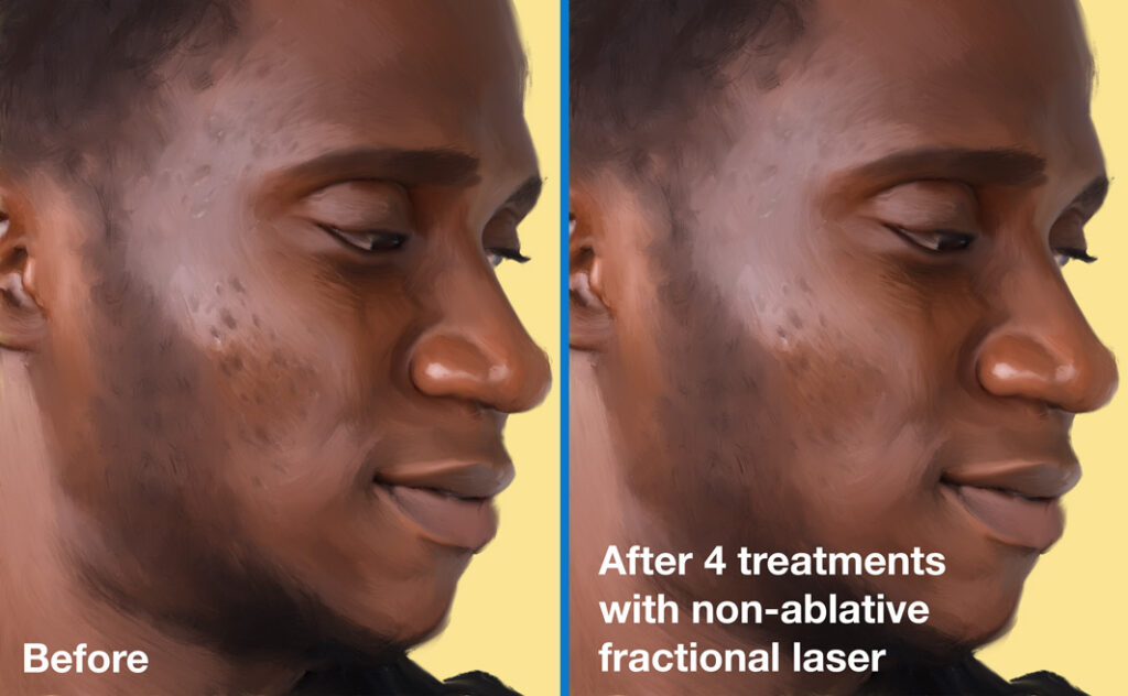 Before and after trying non-ablative fractional laser