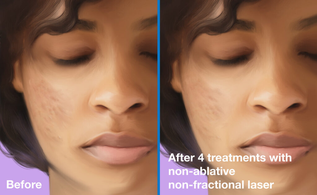 Acne scars before and after 4 treatments with non-ablative non-fractional laser