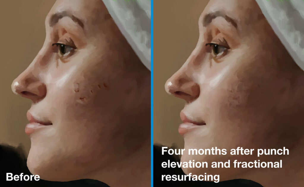 Atrophic acne scars before and 4 months after punch elevation and fractional resurfacing