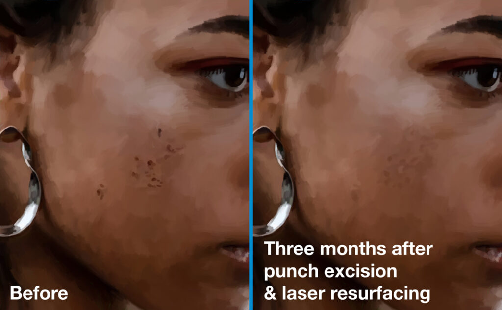Scars before and 3 months after punch excision and laser skin resurfacing.