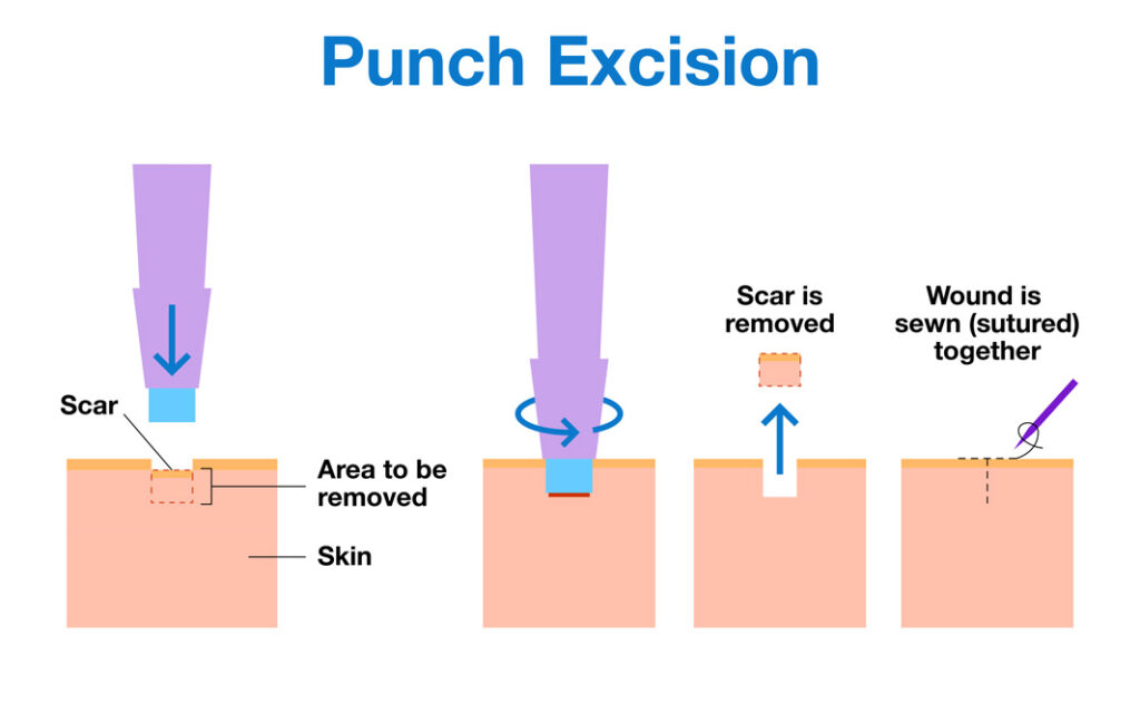 Punch excision infographic