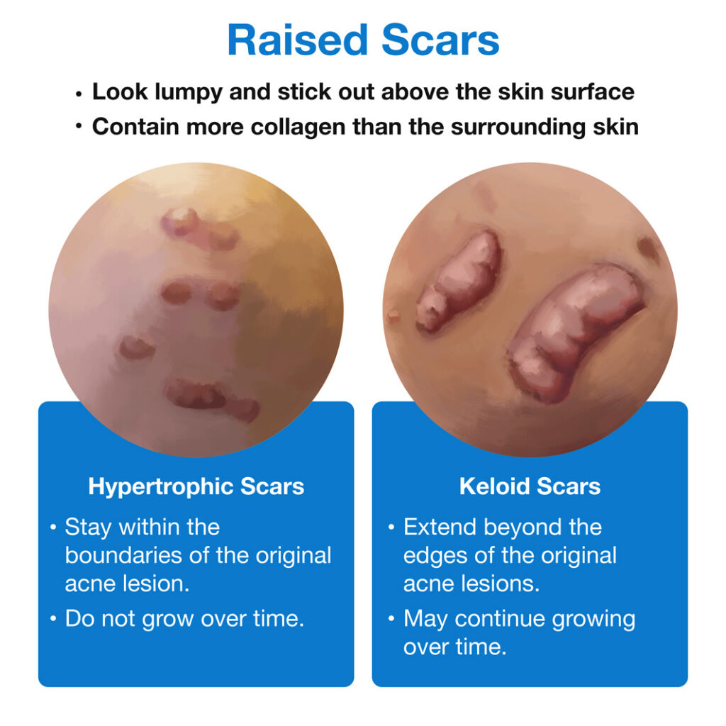 Raised Scars Infographic