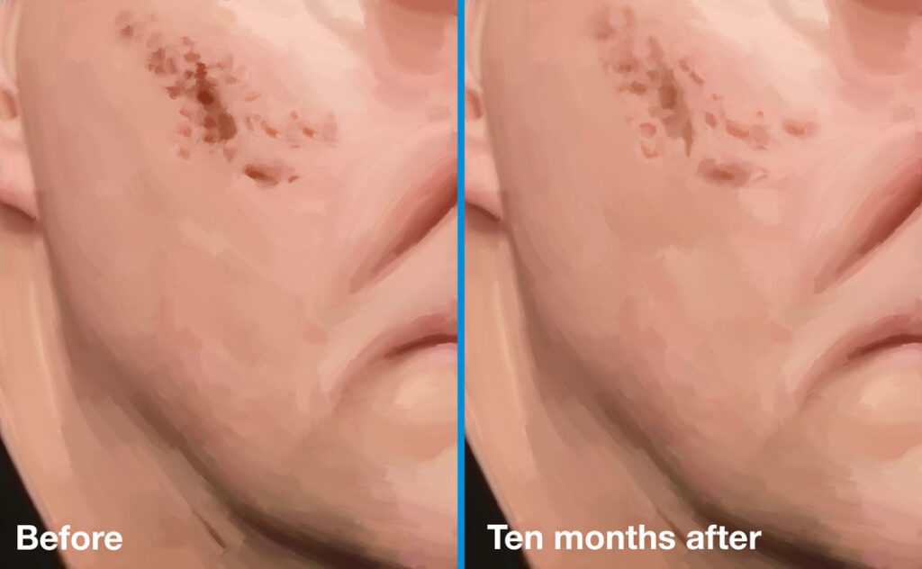 Rolling scars before and 10 months after subcision.