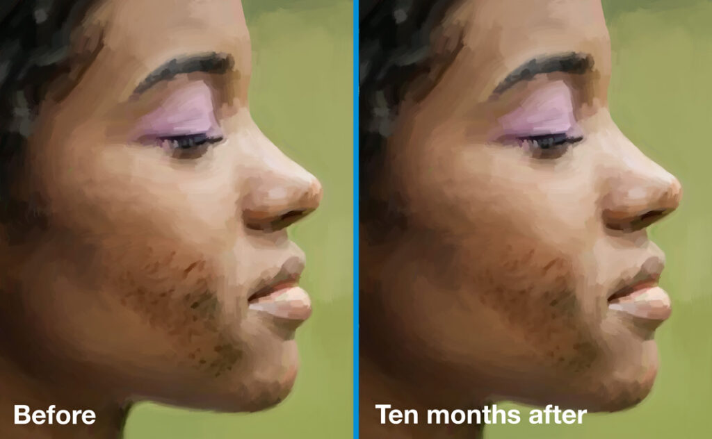 Acne scars before and 10 months after subcision.