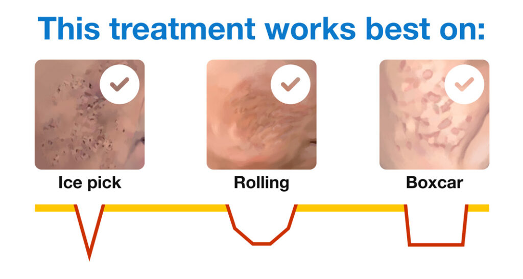 Medium-depth chemical peel works best on ice pick, rolling, and boxcar scars