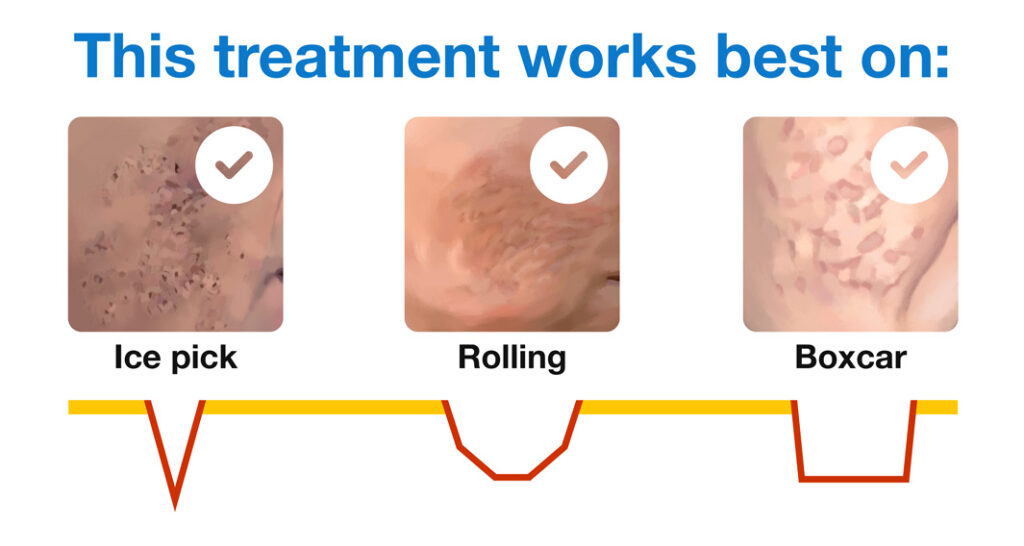 Ablative fractional laser works best on ice pick, rolling, and boxcar scars