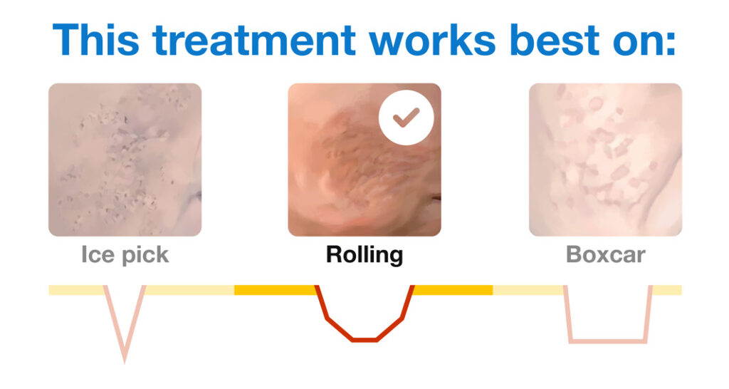 Subcision works best on rolling scars