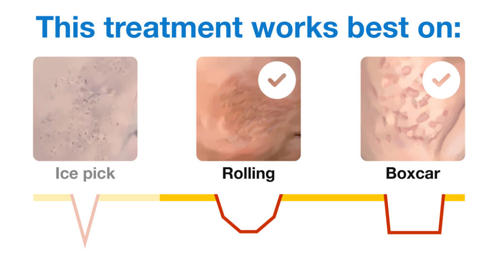 Augmentation works best on rolling and boxcar scars