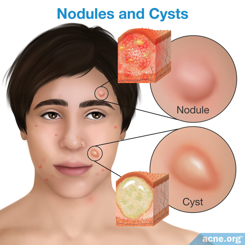 Nodules and Cysts