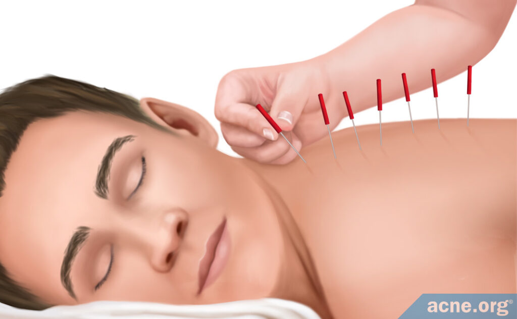 Alternative Therapies for Acne: Acupuncture