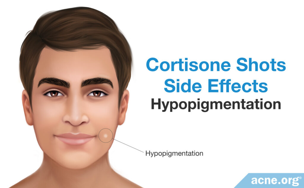 Cortisone Side Effects: Hypopigmentation